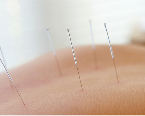 Acupuncture.webp