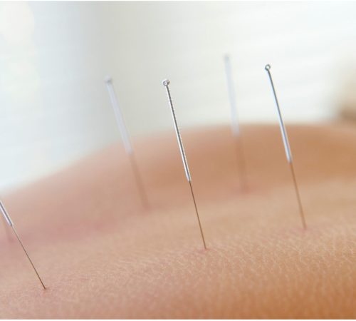 Aupuncture Massage Therapy in Port Credit