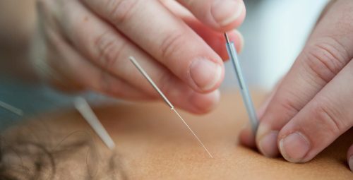 Acupunture benefits port credit